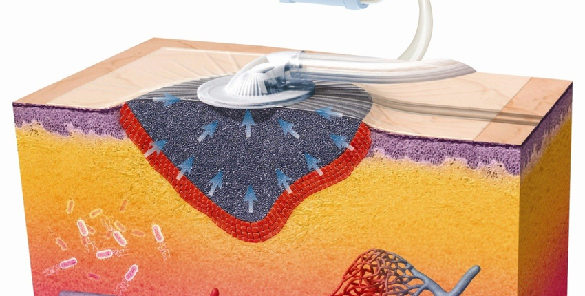Figure-2-Vacuum-Assisted-Closure-VACR-The-figure-shows-the-foam-dressing-fitted-850x430 Servizi